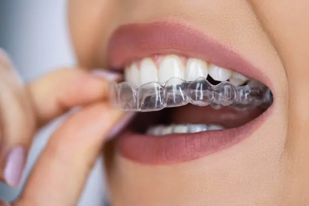 a woman carefully placing clear retainers onto her upper teeth, highlighting proper usage and fit for orthodontic care