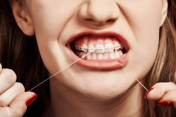 a woman with braces carefully using a floss threader to clean between her teeth