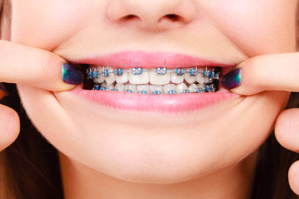 a close-up of a person smiling, showing blue-colored braces on their teeth