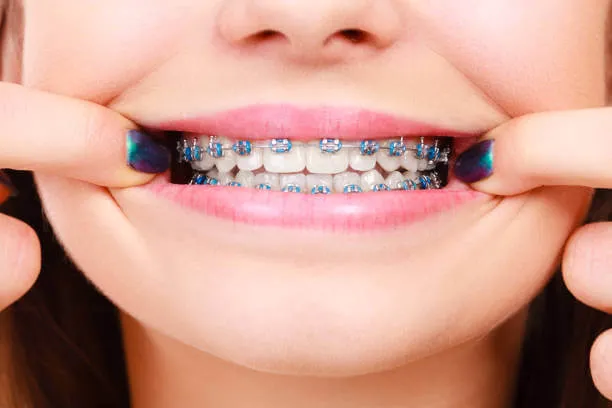 a close-up of a person smiling, showing blue-colored braces on their teeth