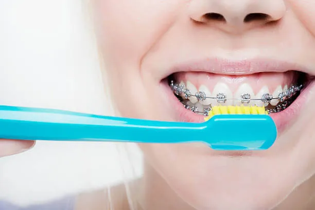 a person with braces brushing their teeth, demonstrating proper oral hygiene