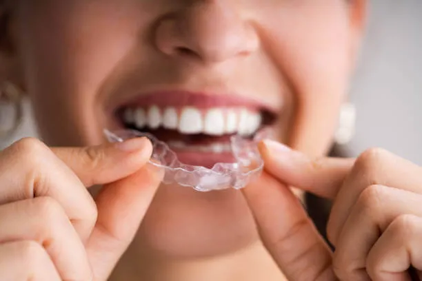 close-up of a person inserting clear Invisalign aligners onto their teeth