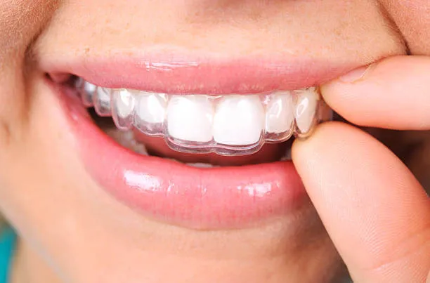 a smiling individual holding and placing Invisalign aligners unto their teeth